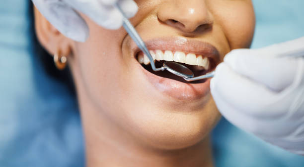 Best Emergency Wisdom Teeth Removal in Moline, IL